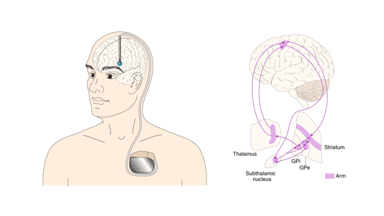 Illustration of DBS system