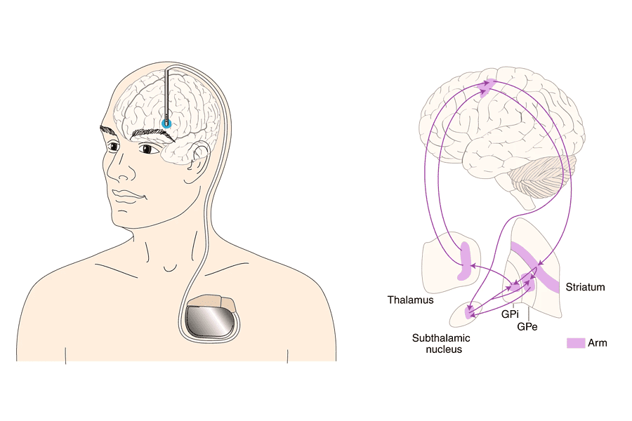 Illustration of DBS system